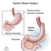 undefined Living with a gastric sleeve