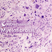 Podcast Medscape InDiscussion: Myelofibrosis